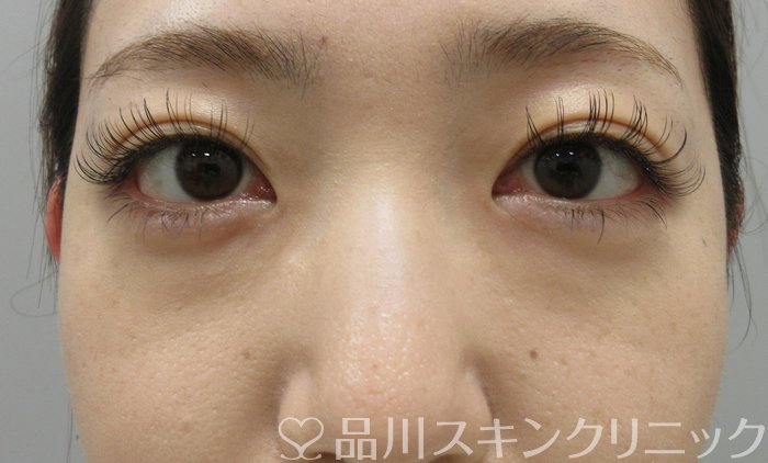 症例NO.74456のBEFORE写真