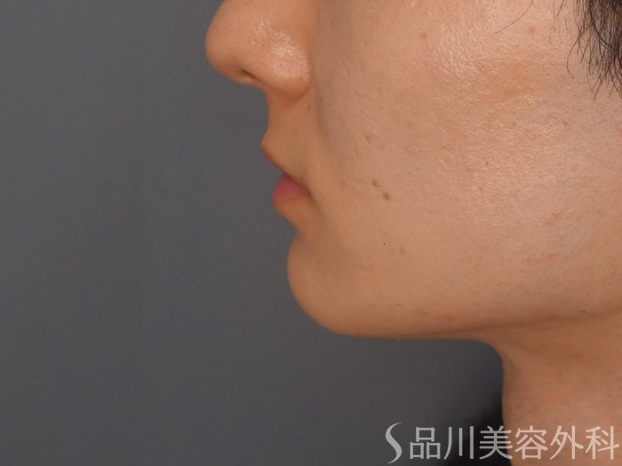 症例NO.72458のBEFORE写真