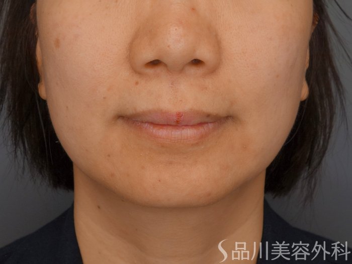 症例NO.72212のBEFORE写真