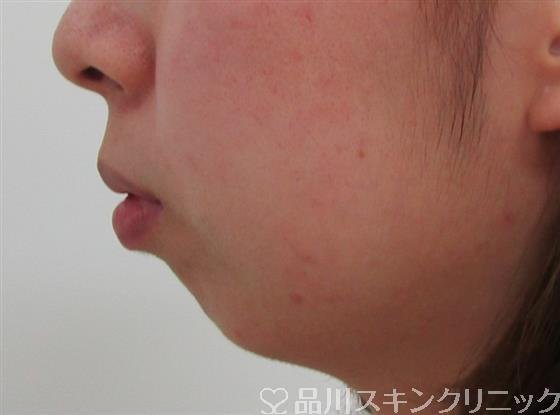 症例NO.34789のBEFORE写真