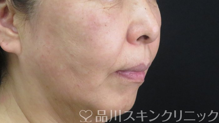 症例NO.71997のAFTER写真