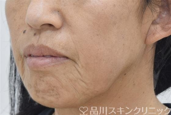 症例NO.43083のBEFORE写真