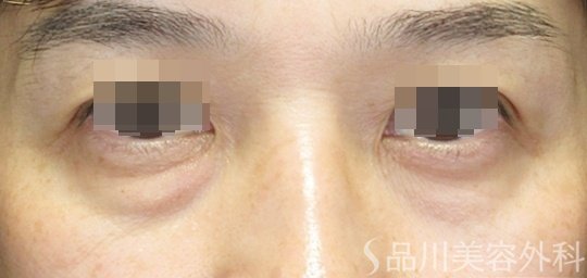 症例NO.71083のBEFORE写真