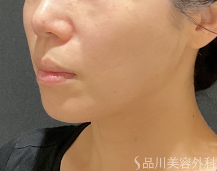 症例NO.74713のAFTER写真