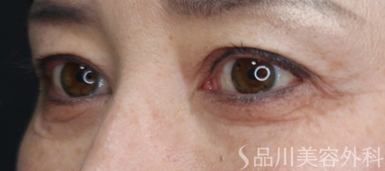 症例NO.75148のBEFORE写真