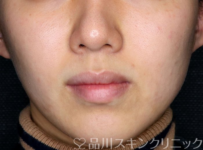 症例NO.75274のBEFORE写真