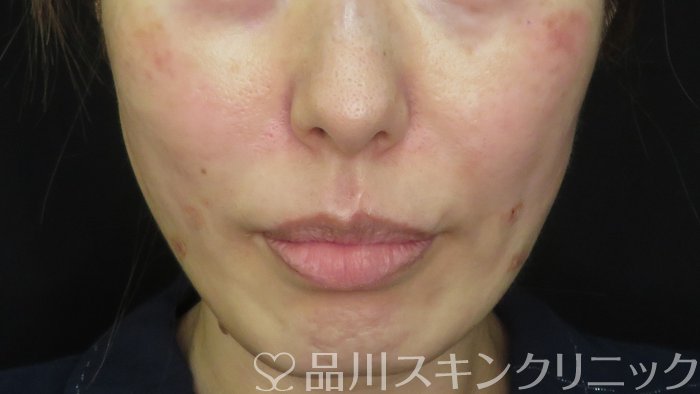 症例NO.71310のAFTER写真