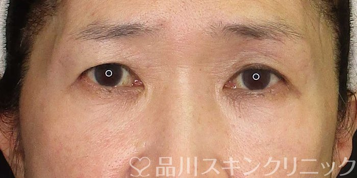 症例NO.70436のAFTER写真