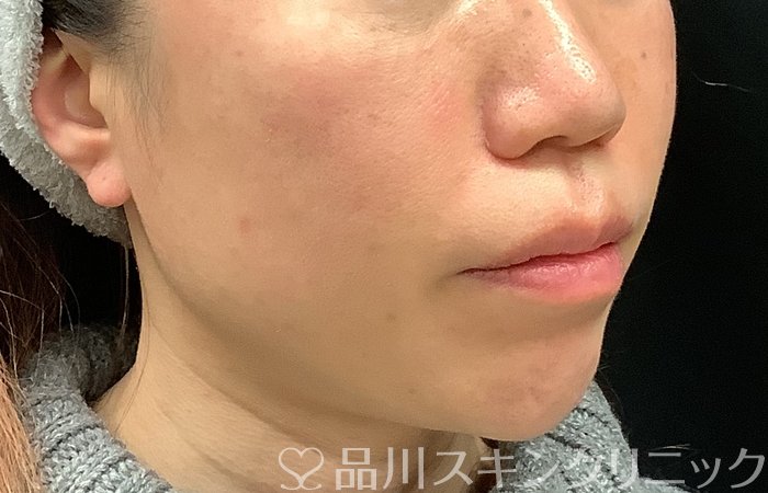 症例NO.69065のBEFORE写真
