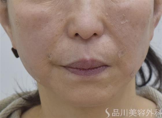 症例NO.51900のAFTER写真