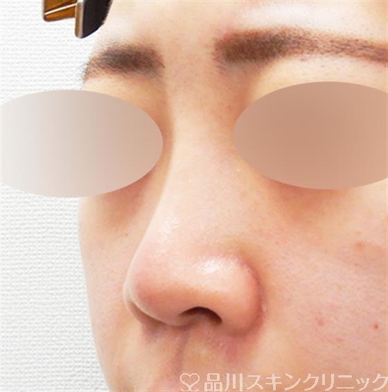 症例NO.55015のAFTER写真