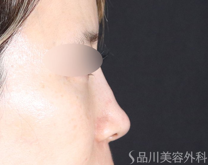 症例NO.74107のAFTER写真