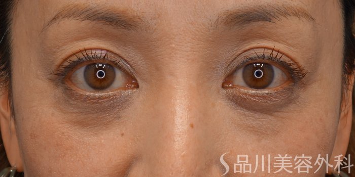 症例NO.74678のBEFORE写真