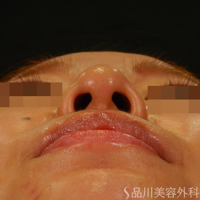 症例NO.65003のBEFORE写真