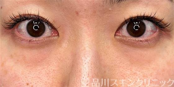 症例NO.60417のBEFORE写真