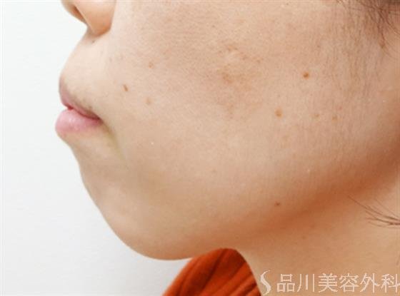 症例NO.32519のBEFORE写真