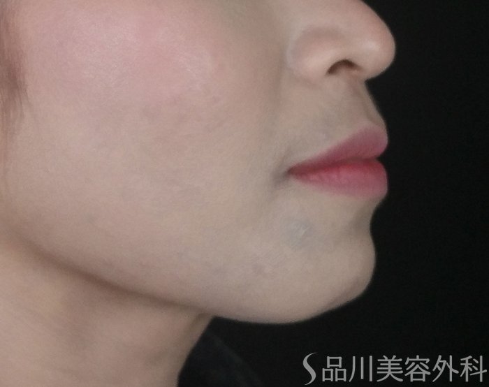 症例NO.69609のAFTER写真
