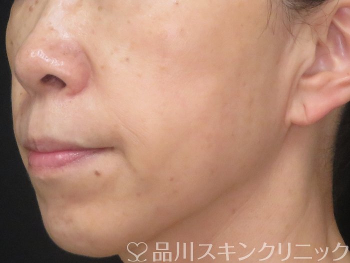 症例NO.70731のAFTER写真
