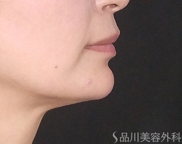 症例NO.65465のAFTER写真