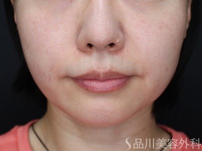 症例NO.71937のBEFORE写真