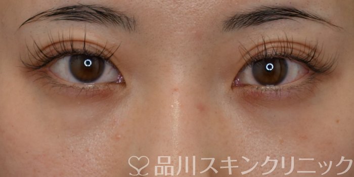 症例NO.74048のBEFORE写真