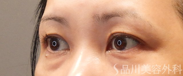 症例NO.72121のBEFORE写真