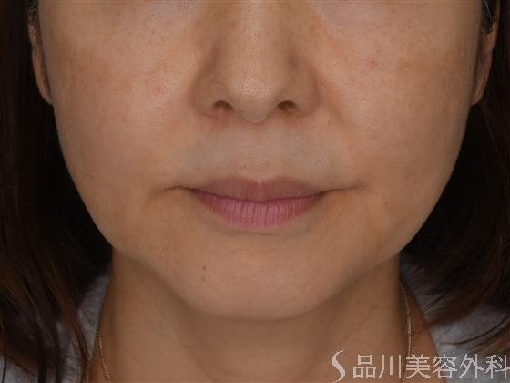 症例NO.52598のBEFORE写真