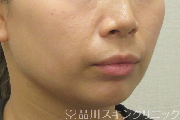 症例NO.74505のBEFORE写真
