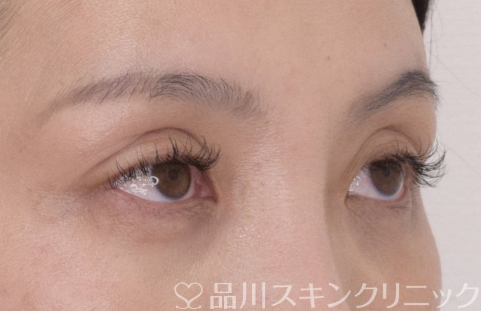 症例NO.70234のBEFORE写真