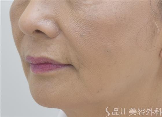 症例NO.44402のAFTER写真
