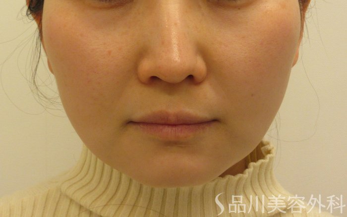 症例NO.70742のBEFORE写真