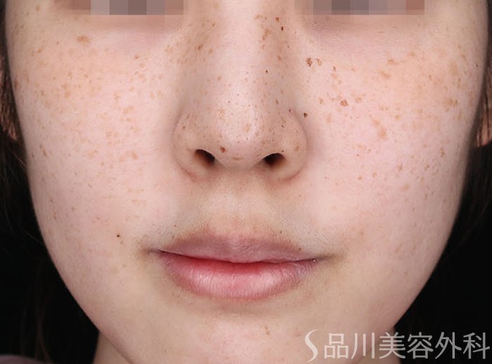 症例NO.72834のBEFORE写真