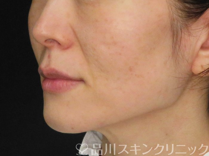 症例NO.62502のBEFORE写真