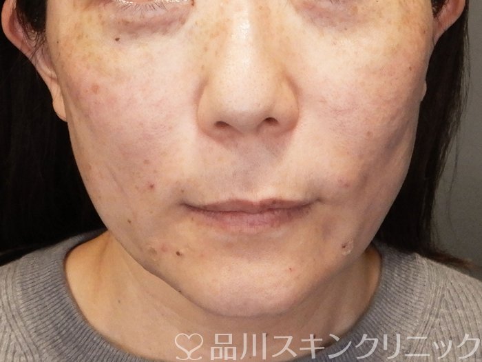 症例NO.70301のAFTER写真