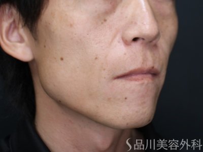 症例NO.75282のBEFORE写真