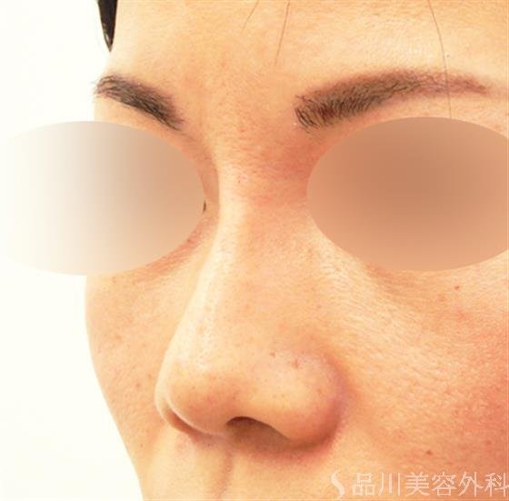 症例NO.51327のAFTER写真
