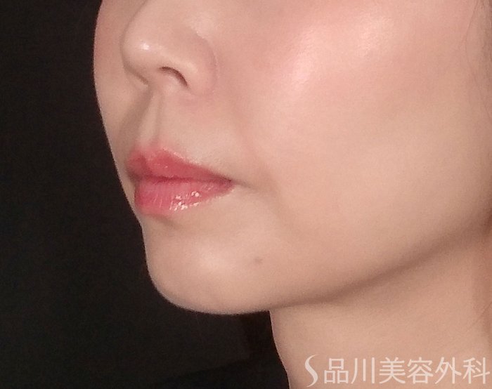 症例NO.70458のBEFORE写真