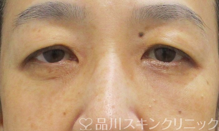 症例NO.71626のAFTER写真