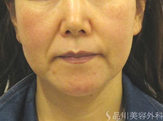 症例NO.42482のBEFORE写真
