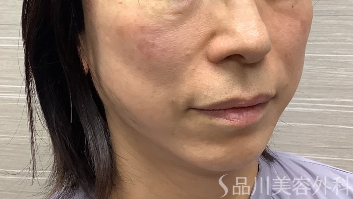 症例NO.62222のAFTER写真