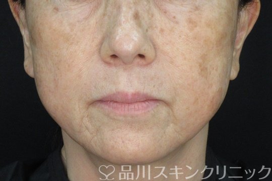 症例NO.72850のBEFORE写真