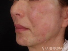 症例NO.73531のAFTER写真