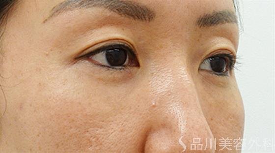 症例NO.44609のAFTER写真