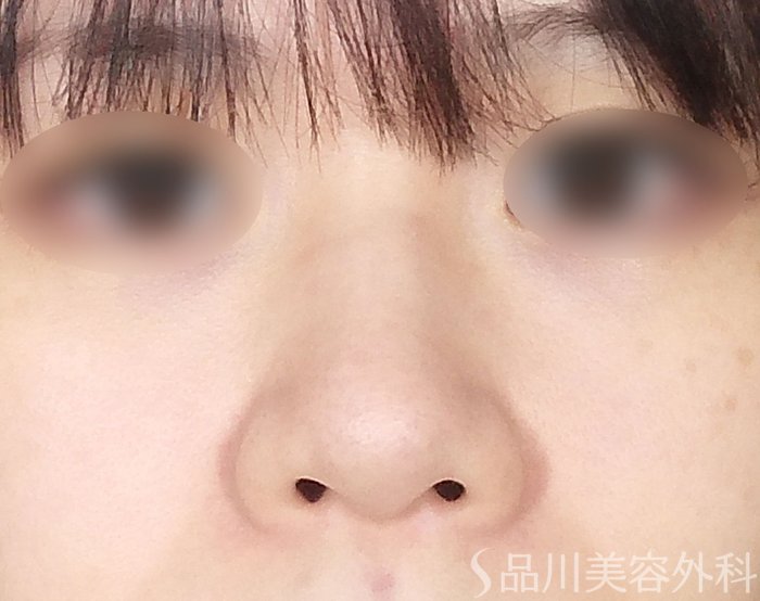 症例NO.68337のBEFORE写真