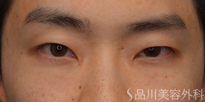 症例NO.74969のBEFORE写真