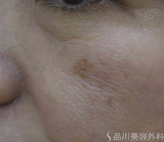 症例NO.45649のBEFORE写真