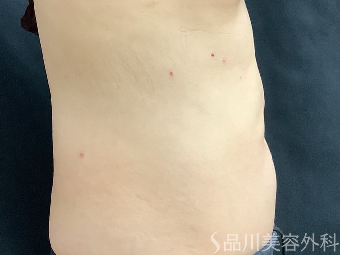 症例NO.75342のBEFORE写真