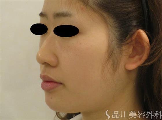 症例NO.48552のBEFORE写真