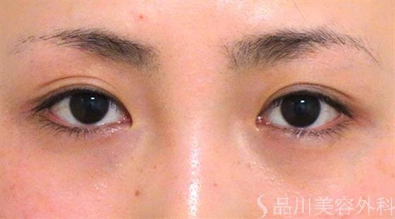 症例NO.27048のBEFORE写真