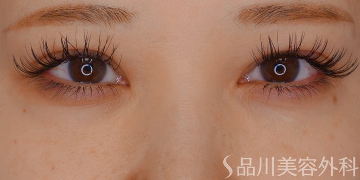 症例NO.73594のAFTER写真